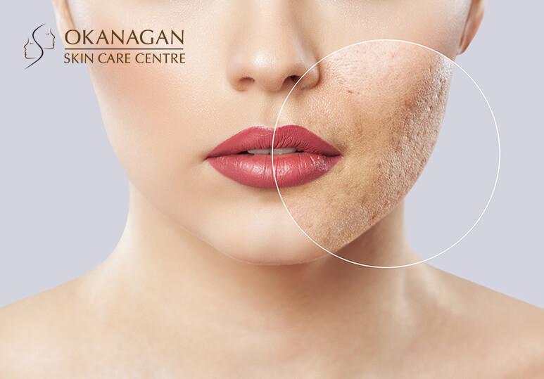 Okanagan Skin Care - blog - Acne